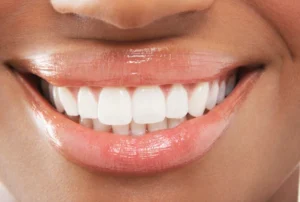 Composite Bonding Croydon Cosmetic Dentist Announces Private Patient Appointments at Smile 4 U Dental Practice