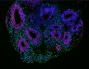 New Study Identifies Key Protein Behind Myelin Repair Failure in Multiple Sclerosis